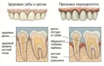 периодонтити симптоми