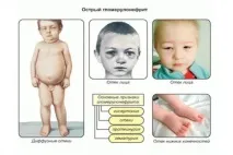 Гострий постстрептококовий гломерулонефрит у дітей форми та види, симптоми, лікування гострий