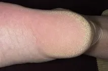 лечението причините