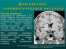 Презентація Геморагічний інсульт, Медицина інсульт