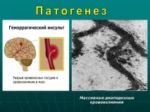 Презентація Геморагічний інсульт, Медицина інсульт