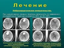 Презентація Геморагічний інсульт, Медицина геморагічний