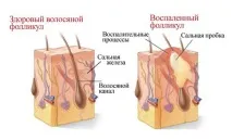 причини лечение