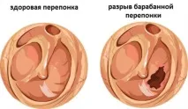 Шум у вухах при застуді та нежиті вусі