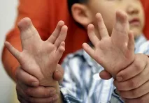 syndactyly показания