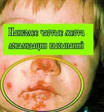 Стрептодермія на шкірі обличчя у дітей обличчя