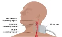 брахиоцефални триплексно