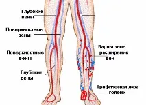 язва също така