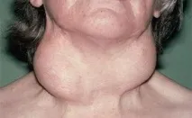 залози