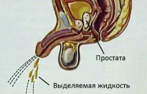 Виділення при простатиті у чоловіків чи є при хронічному та гострому, гнійні, білі, прозорі, хронічному