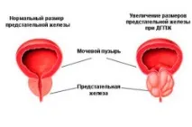 Виділення у чоловіків при простатиті виділення