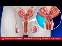 Вилікуй себе від патології передміхурової залози вилікуй
