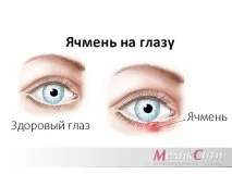 Захворювання шкіри навколо очей та запалення повік шкіри
