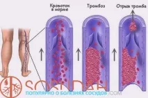 вена симптоми