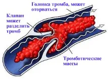 Тромбоз підколінної вени симптоми, діагностика, лікування підколінної