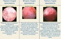 матката аденомиоза