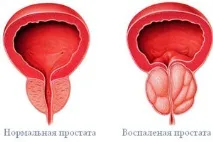 Аналіз секрету простати - що це і як його роблять, САЙТ ПРО ЗДОРОВ’Я ТА МЕДИЦИНУ аналіз