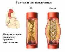 стентиране артерии