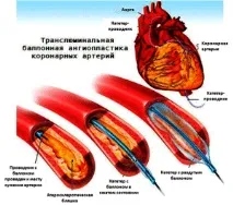 коронарни Ангиопластика стентиране