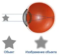 Короткозорість корекції