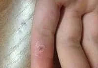 Болить папілома - що робити при цьому і чому вона може хворіти цьому