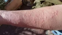 уртикарията уртикарията