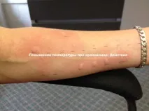 треска уртикарията