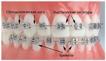 брекети