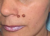 лицето могат брадавици
