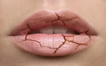 Що робити, якщо сохнуть губи - Догляд за шкірою обличчя та тіла якщо