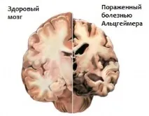 Деменція – що це таке Види та симптоми таке