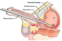 Якщо вас торкнулося захворювання на простатит, вам потрібне термінове лікування якщо