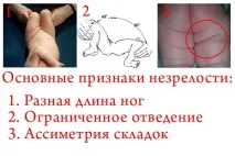 Фізіологічна незрілість кульшових суглобів у новонароджених особливості, типи та лікування кульшових