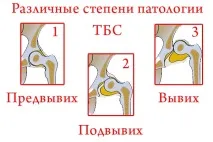 Фізіологічна незрілість кульшових суглобів у новонароджених особливості, типи та лікування новонароджених