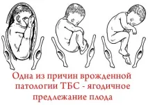 Фізіологічна незрілість кульшових суглобів у новонароджених особливості, типи та лікування фізіологічна