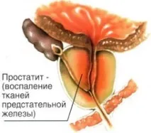 Якщо вас торкнулося захворювання на простатит, вам потрібне термінове лікування Захворювання