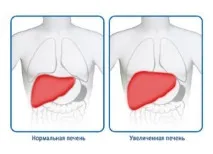 увеличени чернодробни