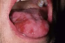 Херпесът езика херпес