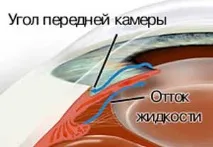 глаукома главкома