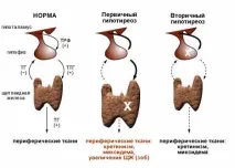 първичен хипотиреоидизъм