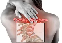 Грижі Шморля що це таке грижі