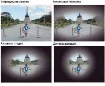 Інвалідність при глаукомі- коли її дають зору