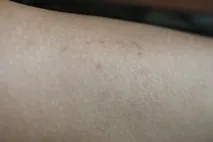 Позбавляємося врослого волосся після