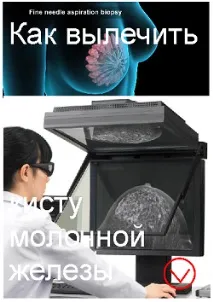 киста гърдата киста