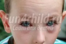 Коньюктивіт у дитини причини, ознаки, лікування та профілактика дитини