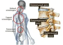 Корсет при остеохондрозі хребта можна