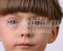 Коньюктивіт у дитини причини, ознаки, лікування та профілактика дитини