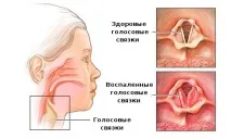 Ларингіт симптоми та лікування лікування