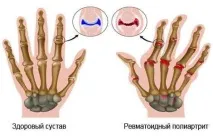 Лікування поліартриту народними засобами народними