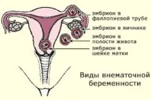 Позаматкова вагітність у яєчникуознаки позаматкова